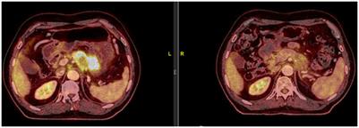 Case report: Immunotherapy guided by molecular profiling of tumors: illustrative cases and literature review